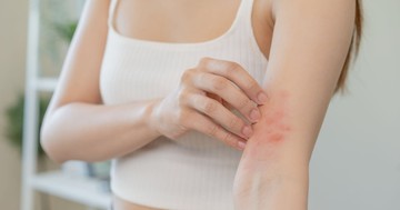 Poloska, bolha vagy hangya csípte meg? Ezek a legjobb módszerek a kínzó viszketés megszüntetésére