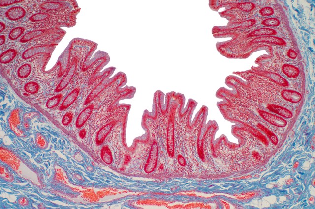 Mikroszkópos colitis: ilyen tünetekkel jár a gyulladásos bélbetegségek (IBD) harmadik típusa
