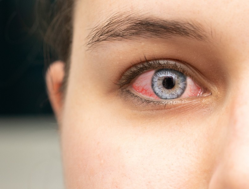 allergia fertőzés kötőhártya gyulladás különbség tünet