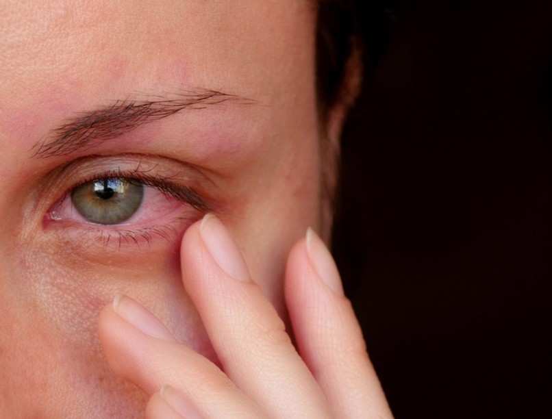 kötőhártyagyulladás, könnyezés oka iridocyclitis