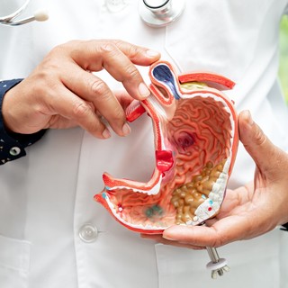 Gyomorfekély, nyombélfekély: tünetei, vizsgálata és kezelési lehetőségei című cikk nyitóképe