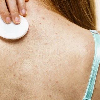 Akné a háton: mitől alakulhat ki, és mit lehet tenni ellene? című cikk nyitóképe