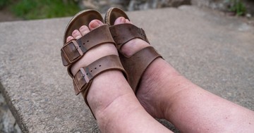  Duzzadt lábak és karok? Lehet, hogy nyiroködéma áll a háttérben 