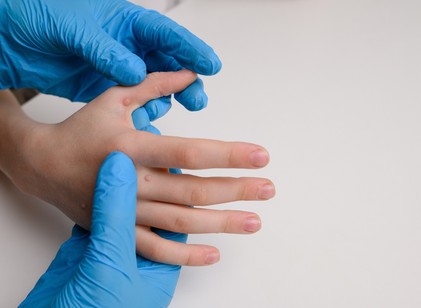 Szemölcseltávolítás lézerrel – fontos tudnivalók, mielőtt belevágna című cikk nyitóképe