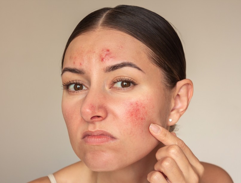 lepkehimlő Miért félünk tőle