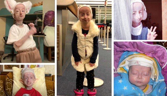 Anja Dobbie: így él egy extra gyorsan öregedő lány