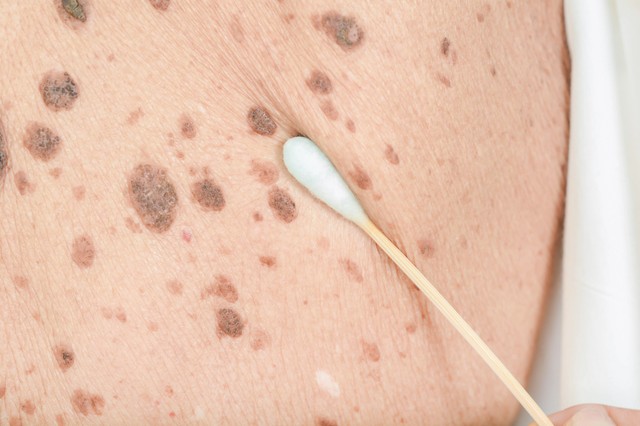 Májfoltok a bőrön: ebben az esetben gyanús, hogy hormonális gondot jelez