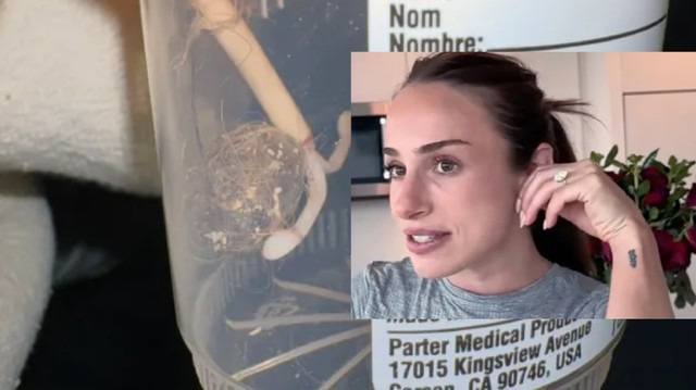 „Rémisztő” szőrgombócot távolítottak el egy nő hüvelyéből - Ez tekeredett a spirálja köré