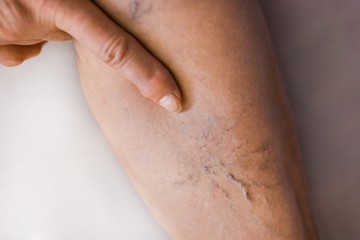 Visszér: ezt lehet tenni otthon, hogy enyhüljön a nehézlábérzés