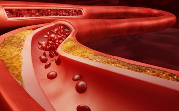 Mit érez, akinek agyvérzése van? 7 jel, amikor már mentőt kell hívni!