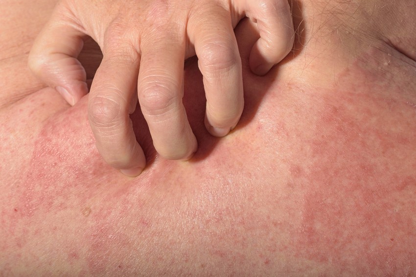 A napallergia pontos kiváltó oka még nem ismert, azonban a hajlamosító tényezők mellett a kialakulásában az UV-A és UV-B sugaraknak egyaránt szerepe lehet.