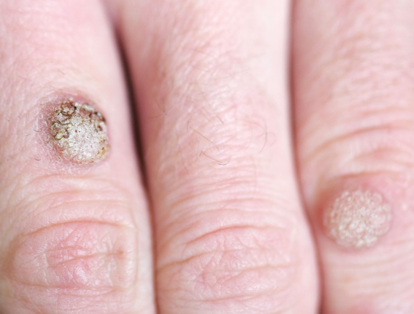 mi jó szemölcs ellen