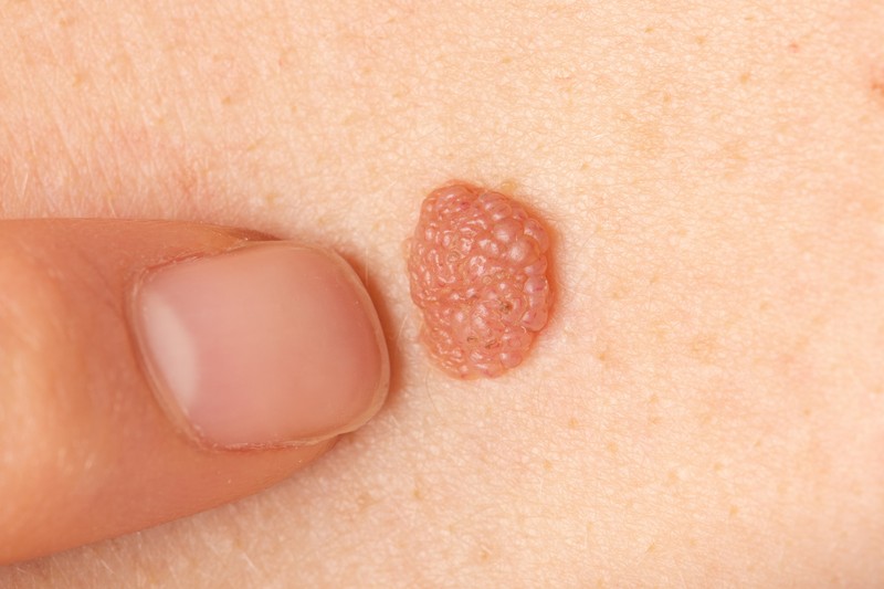 Bőrrák, anyajegy vagy növedék? Így derítheti ki!