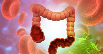  Ennyire komoly betegségeket idézhet elő, ha megbomlik a bélflóránk egyensúlya! 