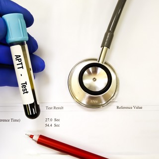 Mit jelent az APTT érték a laborleleten? című cikk nyitóképe