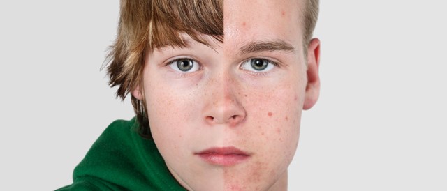 Már kisfiú korban is lehet alacsony a tesztoszteronszint! Ezek a tünetei