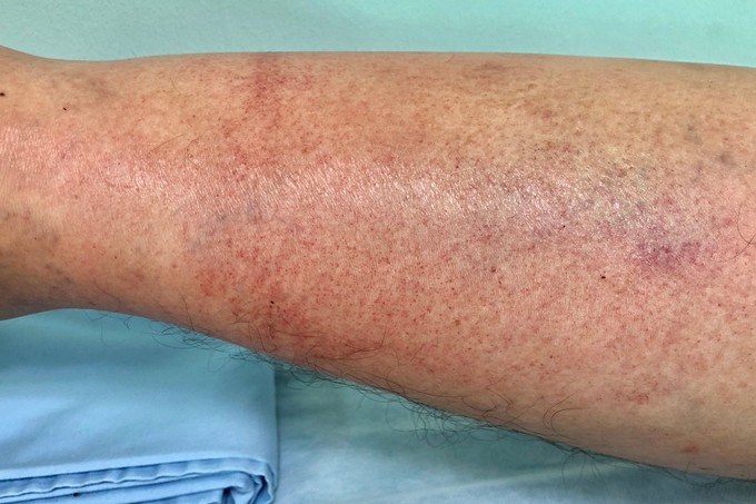 Pontszerű bevérzések a bőrön: ilyenkor jeleznek alacsony vérlemezkeszámot című cikk nyitóképe