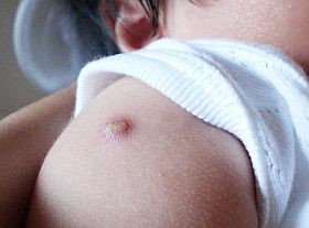 Mit kell tudni a BCG-oltásról?