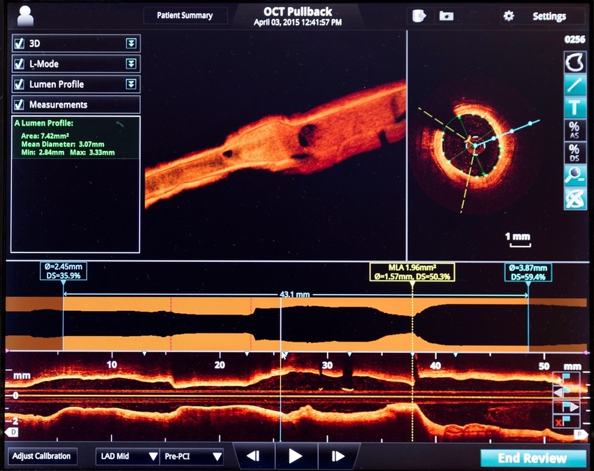 A CAPTURE vizsgálat öt kontinens 13 országában gyűjtött adatokat a CVD előfordulásáról 2-es típusú diabetesben. Demográfiai és klinikai adatok regisztrálásán túlmenően vizsgálták, hogy a terápiában milyen gyakorisággal szerepelnek azok az új antidiabetikumot, amelyeknek kardiovaszkuláris előnyét randomizált, kontrollált vizsgálatokban korábban már igazolták.