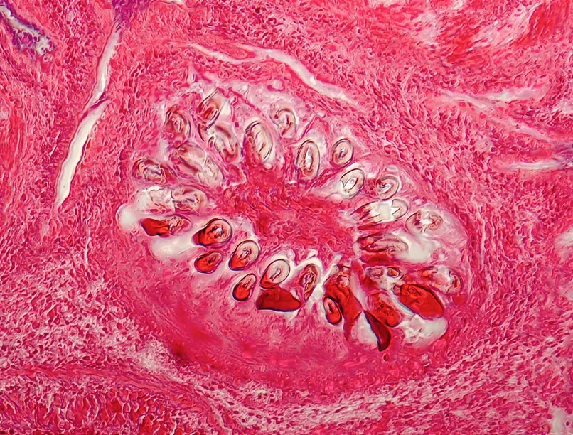 galandféreg fertőzés parazita hasi fájdalom fogyás