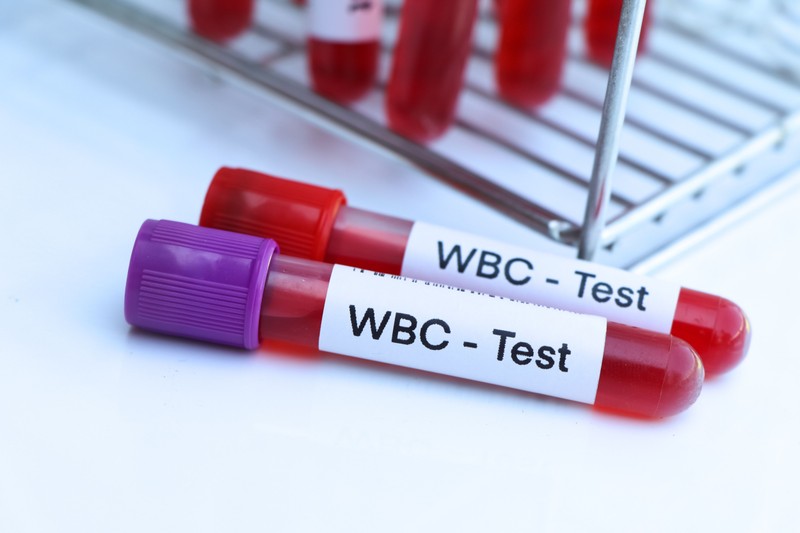 Akár leukémiára is utalhat az, ha magas a leukocyta-száma