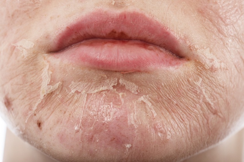 Krónikus táplálékallergia is megnyilvánulhat a bőr nagyfokú szárazságában, korpázó jellegű hámlásában, pirosasságában. Ugyanígy, hámlást okozhatnak a széles körben elterjedt, különféle tusfürdők, szappanok, egyéb kozmetikai cikkek használata. 