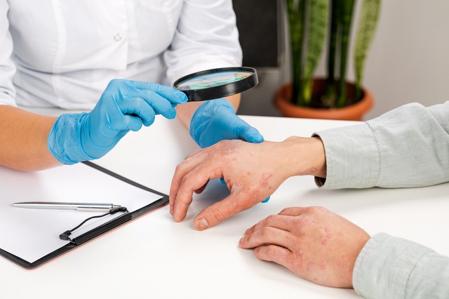 Hogyan kezeljem a stressz okozta ekcémát? Az orvos válaszol