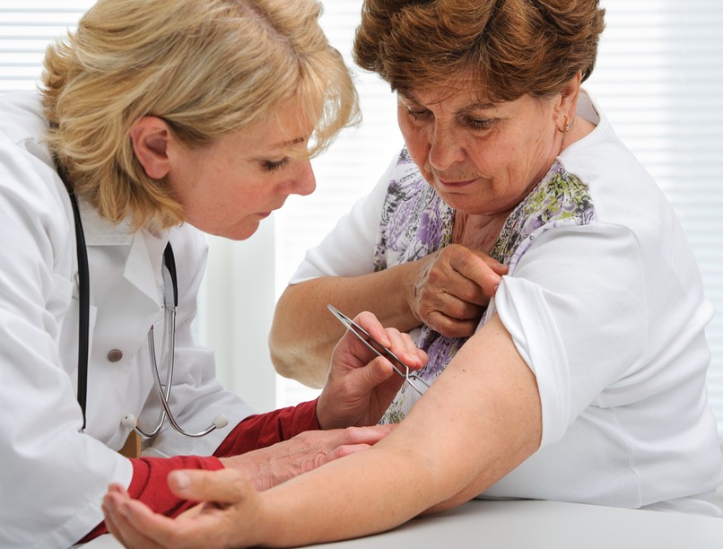 kullancs, kullancscsípés, kullancs eltávolítás