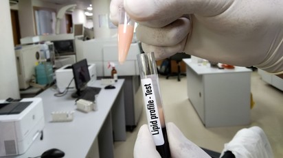 Felborult a lipidprofilja? Ezzel a 8 egyszerű lépéssel fellélegezhetnek az erei című cikk nyitóképe