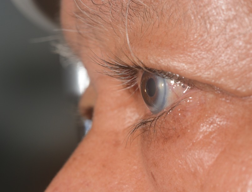 öröklott magas koleszterinszint jele