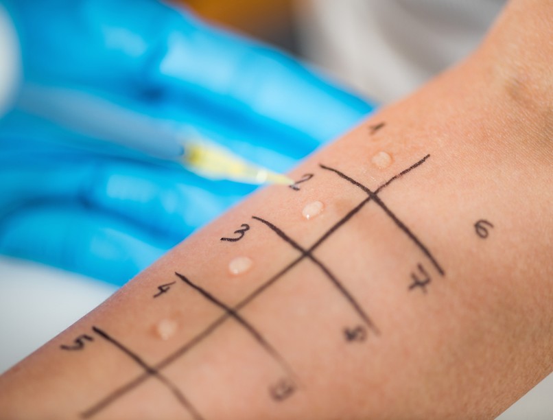 allergiateszt, bőrpróba, Prick-teszt, bőrteszt, ételallergia, pollenallergia