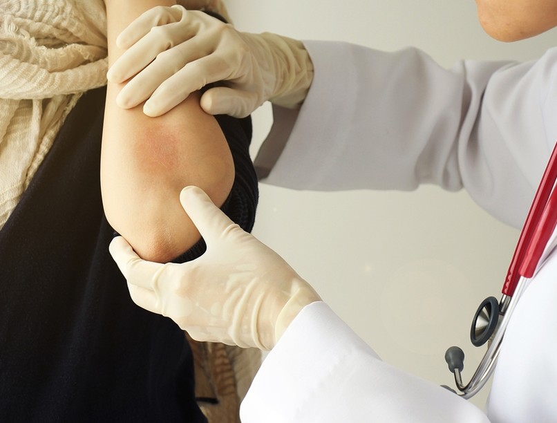 bőrkiütés, ekcéma, covid, vírus, vakcinainfó, orvos válaszol