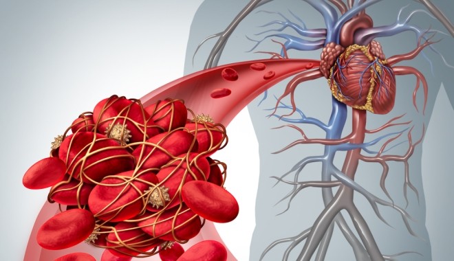 Pfizer: ilyen hatással van a trombózisra hajlamos szervezetre
