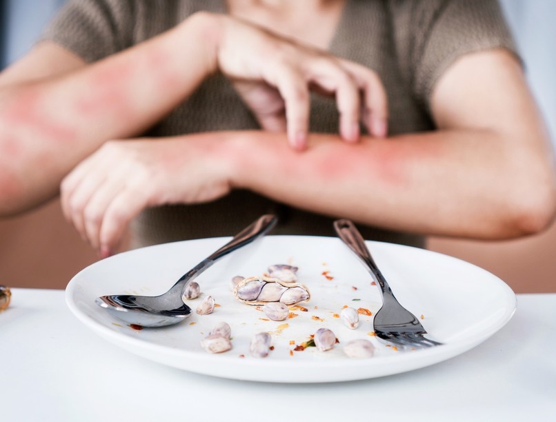 allergia, étel intolerancia, kiütés