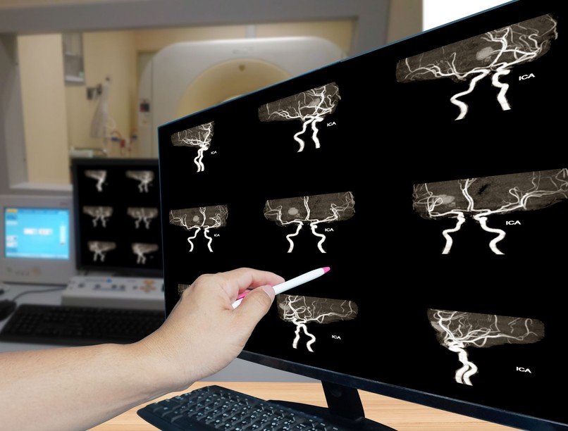 sztrok hogyan ismerhető fel vérzéses stroke