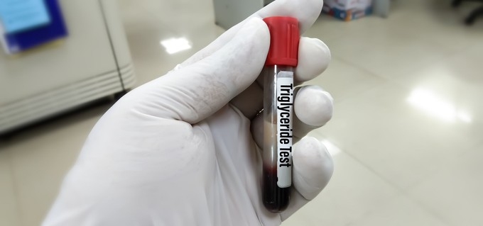 Mit jelent a triglicerid érték a laborleleten? című cikk nyitóképe