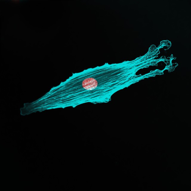 Megjósolhatóvá válhat az áttét? Új módszer jelezte, mekkora eséllyel képez áttétet a rák