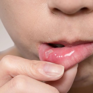 A B12-hiány első jelei a szájban jelenhetnek meg – ezekre figyeljen! című cikk nyitóképe