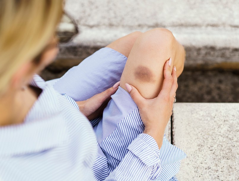 véraláfutás oka miért vérzékenység leukémia