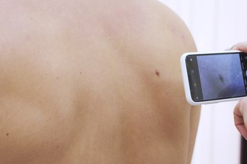 Hogyan alakulhat ki anyajegyből melanóma? Ezeket az elváltozásokat figyelje a bőrén!