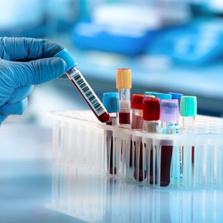 Ez az antitest már évekkel előre jelezheti a sclerosis multiplex kockázatát című cikk nyitóképe
