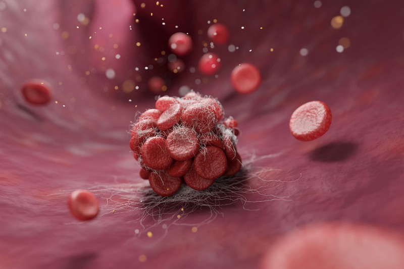 Ez az egy szokás akár az életét is megmentheti – így előzze meg a vérrögöket