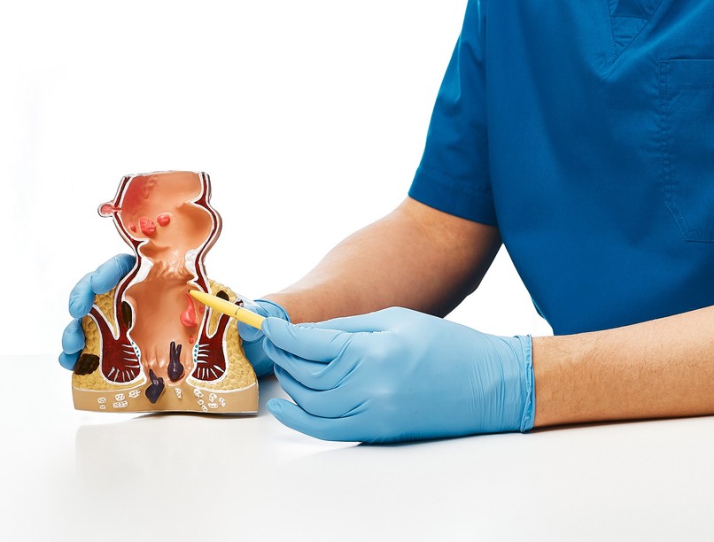 mitől alakul ki a vastagbélpolip