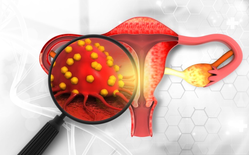 Mi a helyzet akkor, ha fájdalmas panaszokat okoz a petefészekciszta, vagy ha nem tűnik el? Vajon műteni kell?