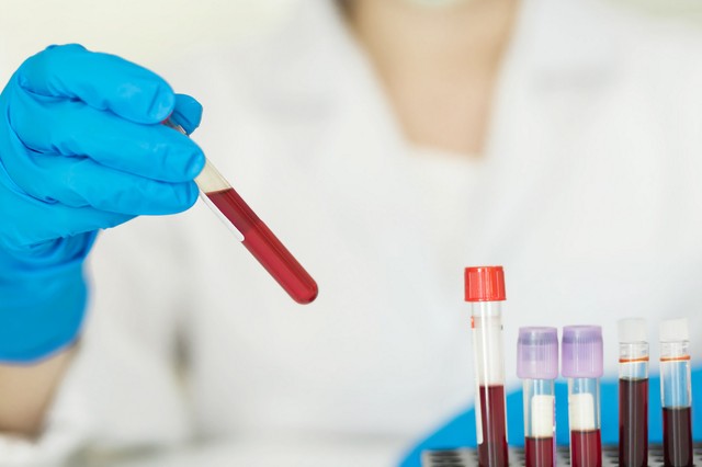 Mit lehet kimutatni egy vérvizsgálatból? Így értelmezze a leleten a jelöléseket