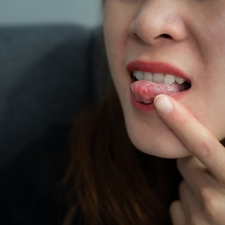 Csomó és folt a nyelv oldalán - vigyázzon, akár nyelvrákot is jelezhet! című cikk nyitóképe