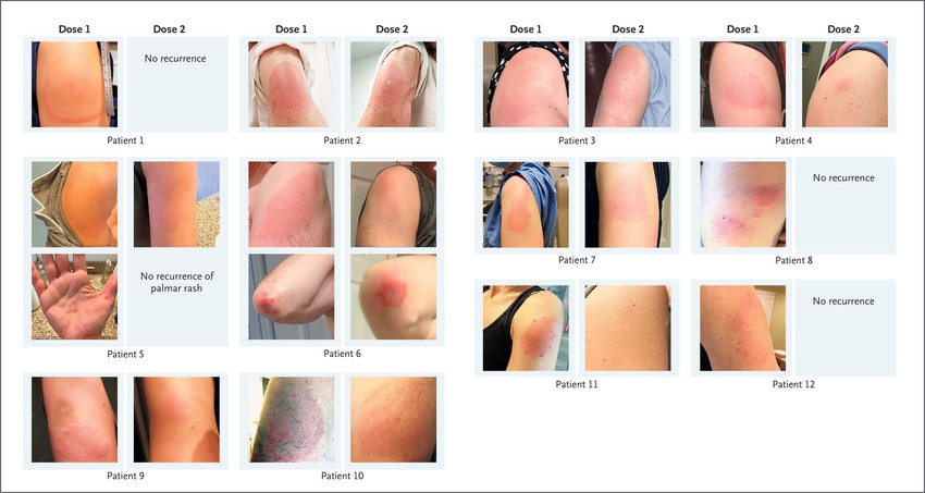 Bőrkiütés védőoltás után