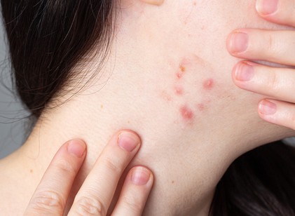 Pattanások a nyakon: nem véletlenül jelennek meg – ezt üzenheti a szervezete című cikk nyitóképe