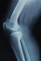 Tudtuk? Az elhízás és a reumatoid artritisz kapcsolata