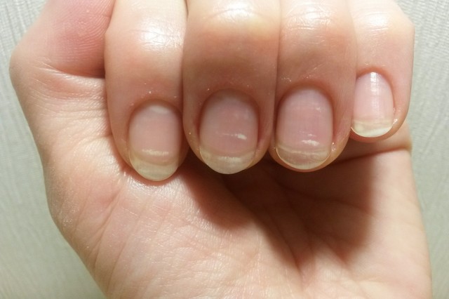 Barázdák, foltok, mélyedések, csíkok a körmön - melyik, milyen problémát jelez?